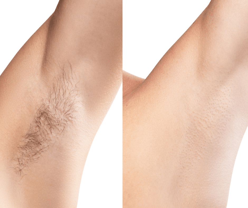 Top Rated Laser Hair Removal Chicago