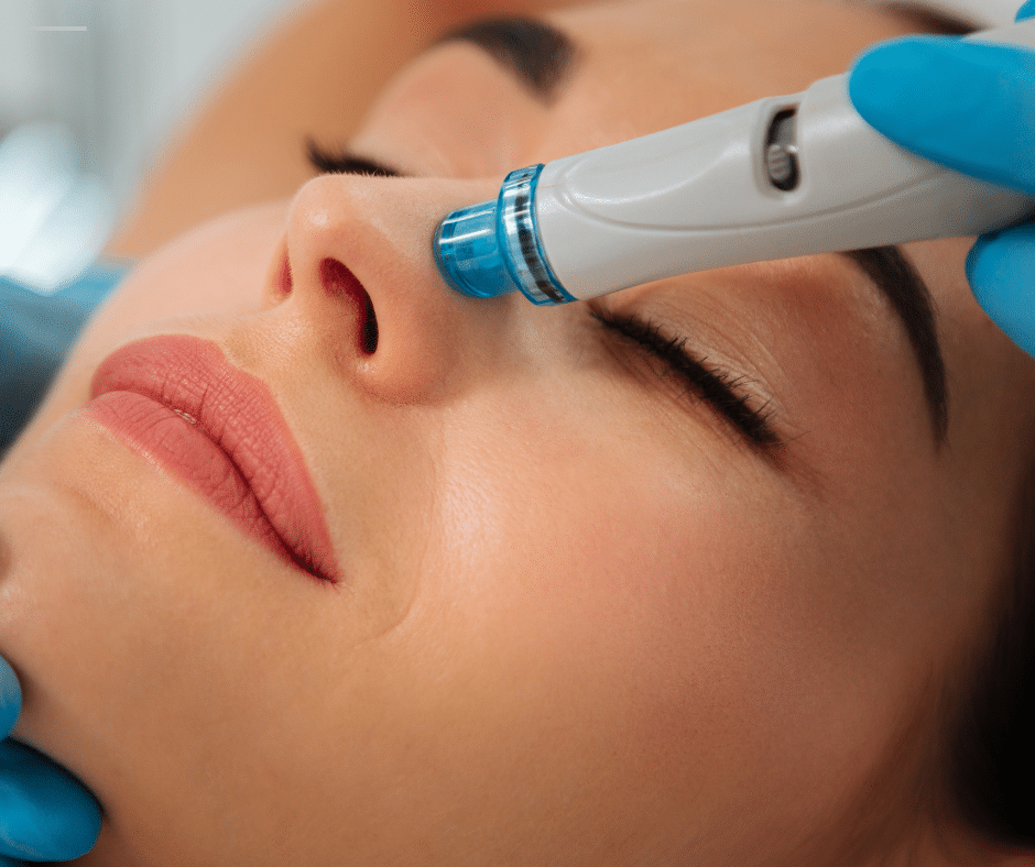 Hydrafacial Benefits for Acne